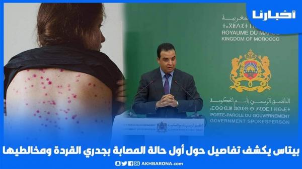 "بايتاس" يكشف تفاصيل أول حالة إصابة بجدري القردة بالمغرب